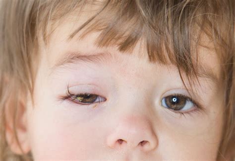 Conjunctivitis In Infants And Children Causes Symptoms And Treatment