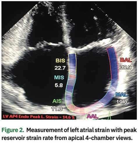 Preserved Left Atrial Function Following Left Atrial Appendage Closure