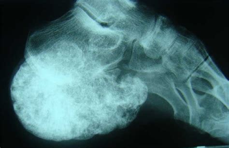 You can also connect up with a support group. 2 Podiatrists, 4 Days in Nicaragua, 30 Surgeries ...