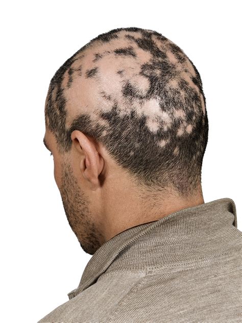 Mens Hair Loss What You Need To Know