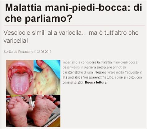 Dr Domenico Cimino Pediatra Malattia Mani Bocca Piedi