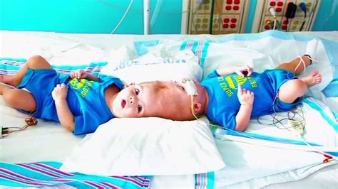 Conjoined At Head Twins Reunited After Risky Separation Surgery In Nyc