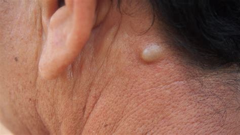 what s a sebaceous cyst signs treatments and what to expect 1md nutrition™