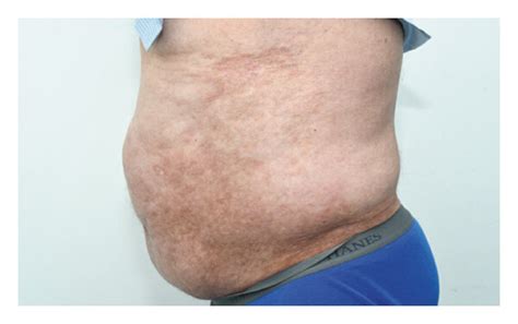 Clinical Photographs Showing Hyperpigmented Indurated Plaques Of The
