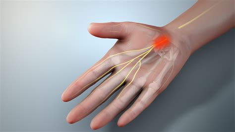 Help For Numbness And Tingling In Your Hand Carpal Tunnel Relief
