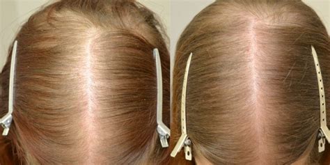 Spironolactone For Females Only Before And After Photos Hair Restoration Of The South New