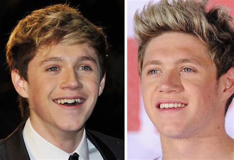 before and after pictures of celebrities who have had their teeth done