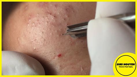 Suri Job 71 Awesome Inflamed Blackheads Extraction Youtube