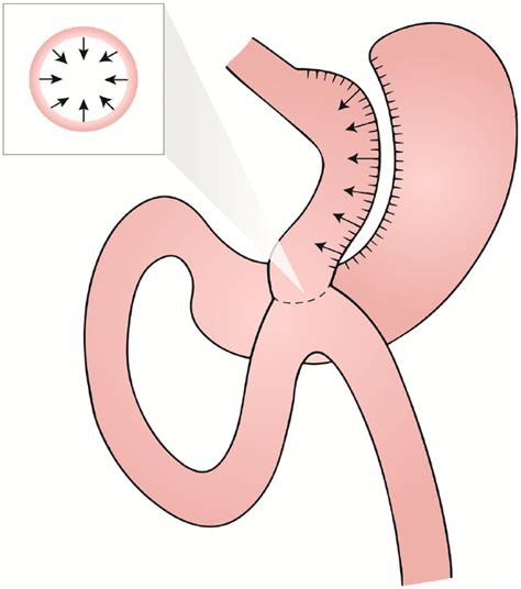 Endoscopic Revision Of One Anastomosis Gastric Bypass Er Oagb For