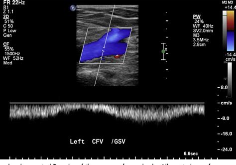 Lower Extremity Venous Ultrasound