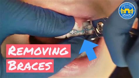 Process Of Removing Braces Youtube