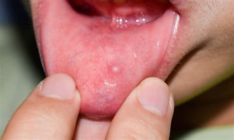 Bump Inside Lip Symptom Causes Treatments Local Dentist