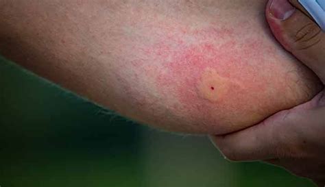 Which Mosquito Bites Sale Cheapest Save 42 Jlcatjgobmx