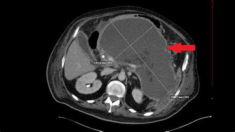 Cureus One Of The Largest Pancreatic Pseudocysts In The Literature A