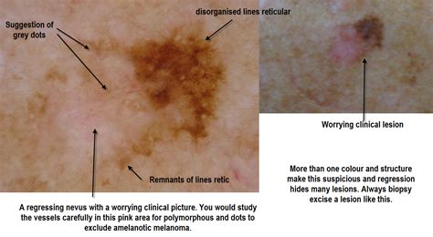 Dermoscopy Made Simple Benign Nevus