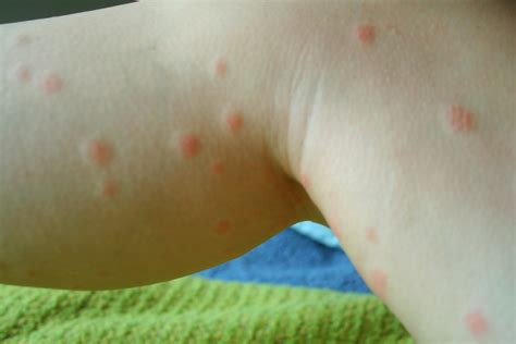 Chigger Bite Vs Bed Bug Bite Identifying Insect Bites Wellbeing Inspiration