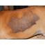 Image Gallery Secondary Skin Lesions  Clinicians Brief