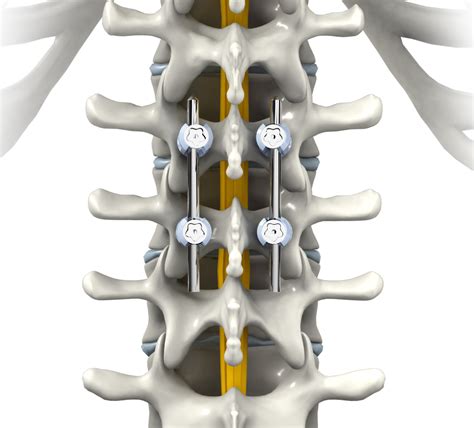 Spinal Fusion Memphis | Spinal Tumor Memphis | Spinal ...