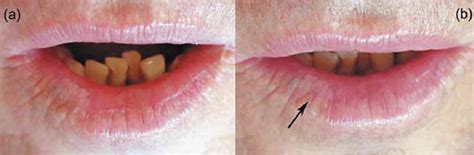 How To Treat Actinic Cheilitis On Lips
