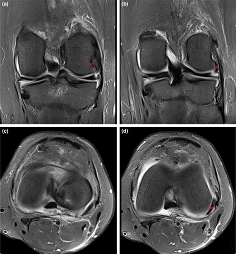 Magnetic Resonance Imaging Of The Knee A Popliteus Tendon Origin In