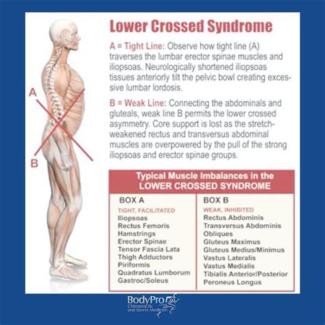 Screening For Upper And Lower Crossed Syndrome Mcisaac Health Systems Inc