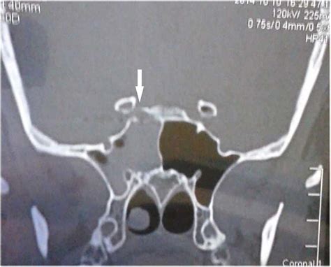 Ct Scan Coronal View Showing Right Sphenoid Sinus Opacification With