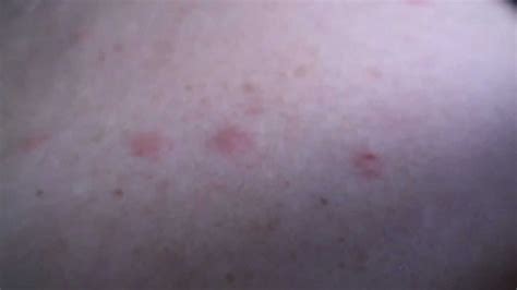 Shingles Rash Early Stages Youtube