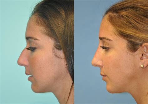 Non Surgical Rhinoplasty Photos Chevy Chase Md Patient 11935