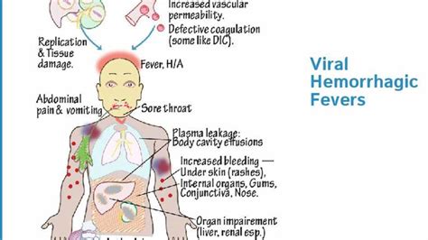 Viral Hemorrhagic Fevers: Sensitive Surveillance System Required To