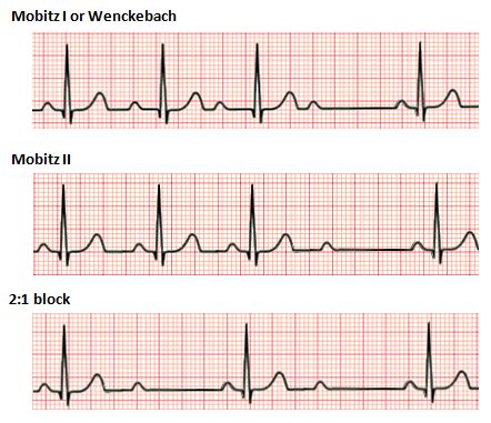 Patients with third degree heart block are at high risk of ventricular standstill and sudden cardiac death. File:Second degree heart block.png - Wikimedia Commons