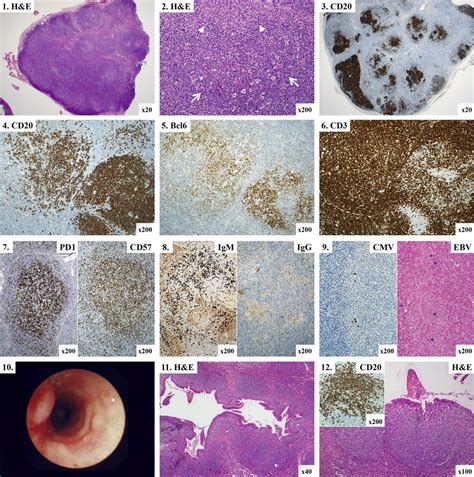 Lymphoid Hyperplasia 1 And 2 Lymph Node Showing Atypical Follicular