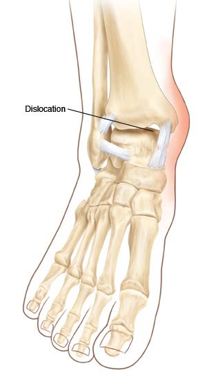 Dislocation Ankle Adult