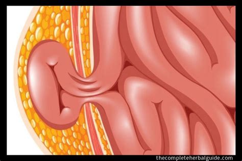 What Are The Various Types Of Hernias That Occur In The Belly Region