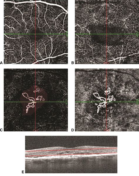 Oct Angiography Of Cnv American Academy Of Ophthalmology