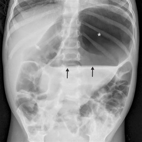 Upright Plain Abdominal Radiograph Showing Markedly Dilated Bowel Loops