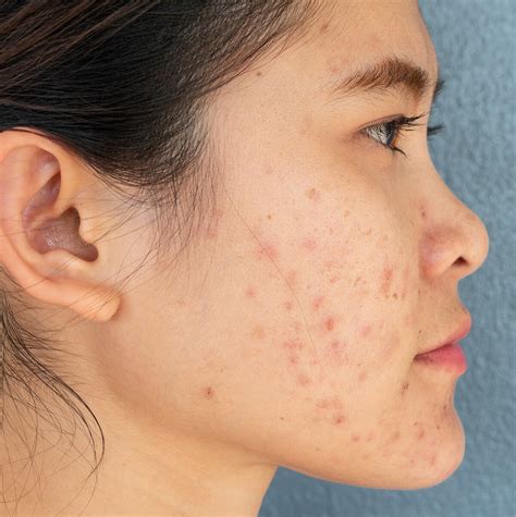 Acne Treatment in Singapore | Dermatologist Dr Wong Soon Tee