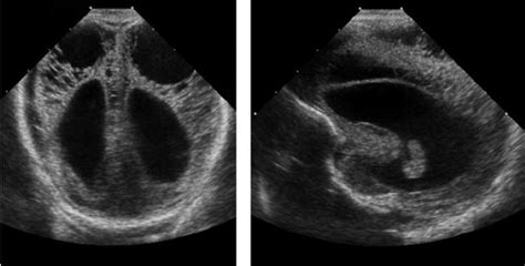 Head Ultrasound Of Twin B Coronal Left And Right Sagittal Right