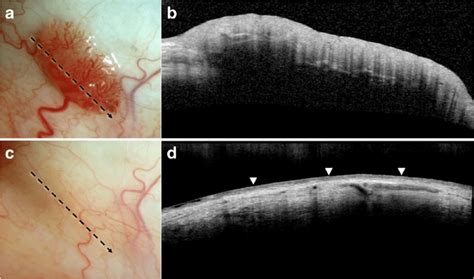 Resolution Of Conjunctival Papilloma On High Resolution Optical