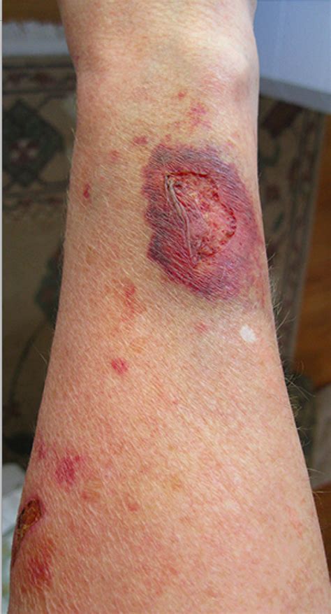 Can steroids increase the size of my penis? Steroid-induced skin atrophy - Wikipedia