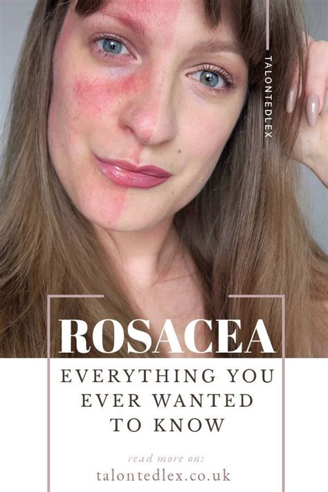 Rosacea Faqs Common Rosacea Questions Talonted Lex Rosacea