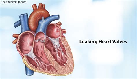 In severe cases of heart valve leakage, one has to undergo surgery in order to replace or repair the damaged valve. Leaking Heart Valves Life Expectancy, Causes, Signs ...