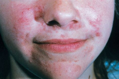 Perioral Dermatitis Here S How To Treat It The Healthy