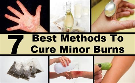 How to treat rope burn. Top 7 Best Methods To Cure Minor Burns | DIY Health Remedy