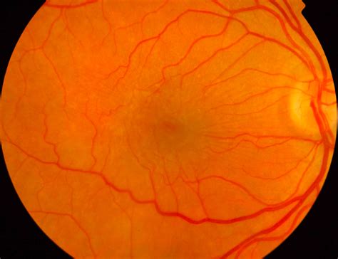 Eye Diseases Retina And Macula Cataract And Glaucoma