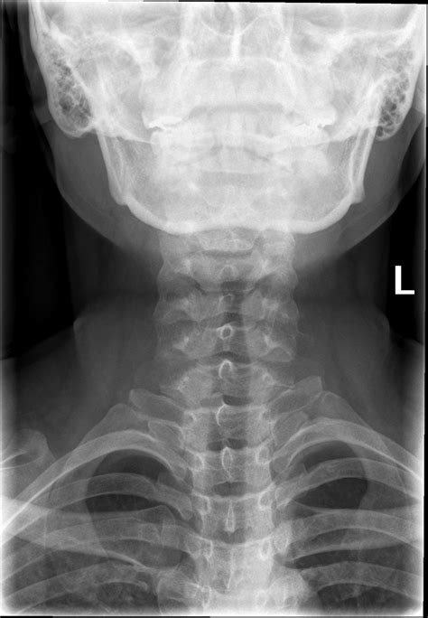 Normal Soft Tissue Neck Radiograph Image