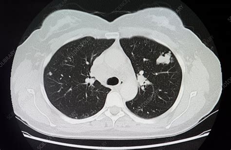 Melanoma Lung Cancer Ct Scan Stock Image C0151233 Science Photo