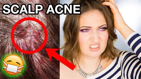 Scalp Acne And Itchy Dandruff How To Get Rid Of It Completely Youtube