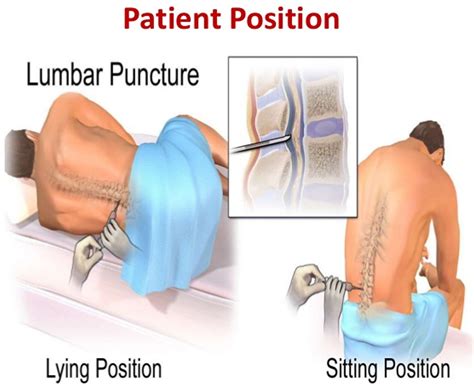 Lumbar Puncture Procedure Position And Lumbar Puncture Side Effects