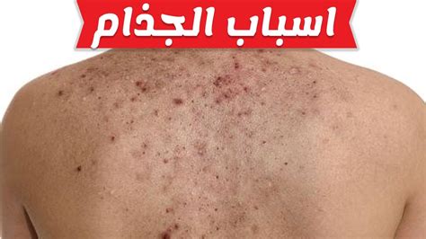 هذا المرض شائع في كل مكان تقريبا. مرض الجذام , اعراض مرض الجذام وعلاجه - كارز