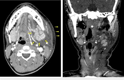 Figure 2 From A Case Of Mumps Presenting With Unilateral Submandibular